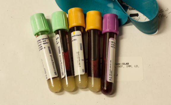 Scientists develop blood test that reveals how fast your organs are aging